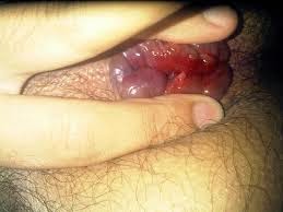 obat benjolan pada anus, ambien benjolan pada anus